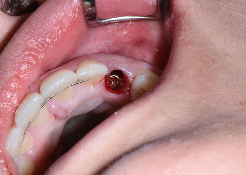 fogászati implantátum